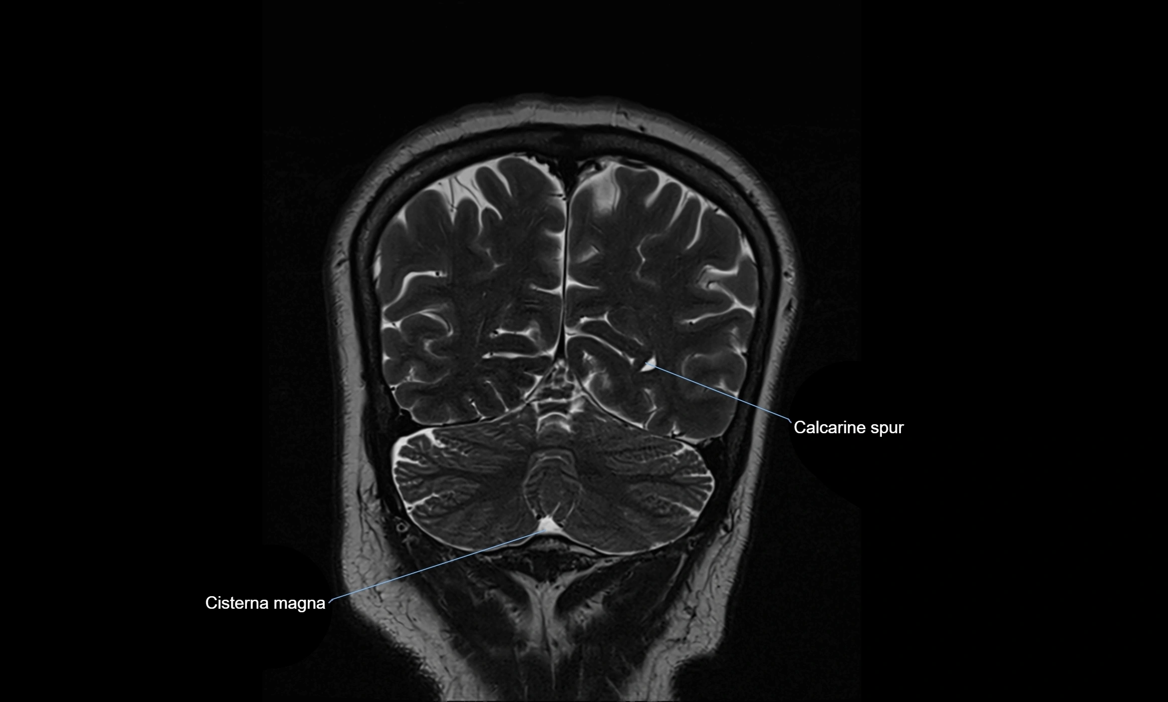 Brain cisterns  and ventricles coronal anatomy 3T MRI image-img-00001-00049.webp